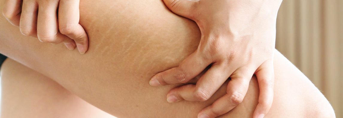 5 astuces pour éviter les vergetures